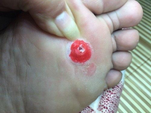 医院挖鸡眼视频,专业除鸡眼过程揭秘