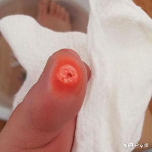 医院挖鸡眼视频,专业除鸡眼过程揭秘