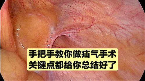 疝气手术视频播放